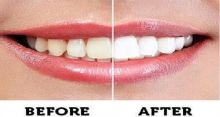 <font style='color:#000000'>Whitening your teeth with activated charcoal</font>